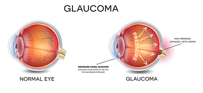Glaucoma is the second leading cause of blindness in the United States. Only about half of the estimated three million Americans who have glaucoma are even aware that they have the condition. When glaucoma develops, typically there are no early symptoms and the disease progresses slowly. Fortunately early detection and treatment can help to preserve vision.